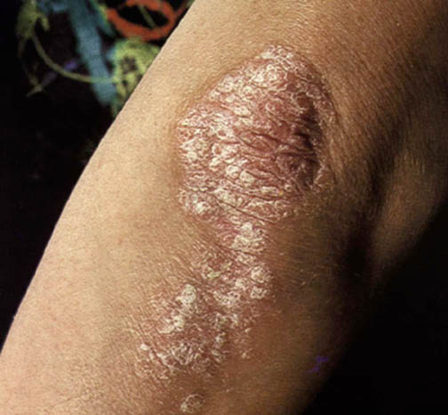 Psoriasi di trattamento di unghie dalle risposte laser