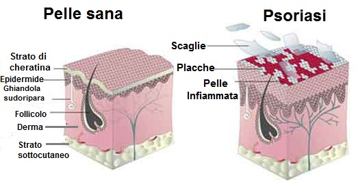 Crema di Ahab da psoriasi