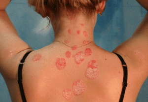 Se aiuta tsindol a eczema