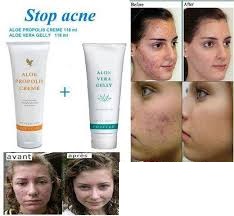 gel aloe vera viso acne