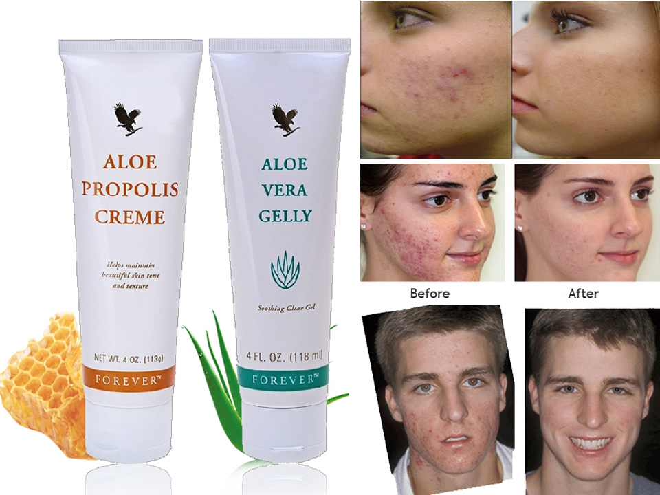 aloe vera viso acne