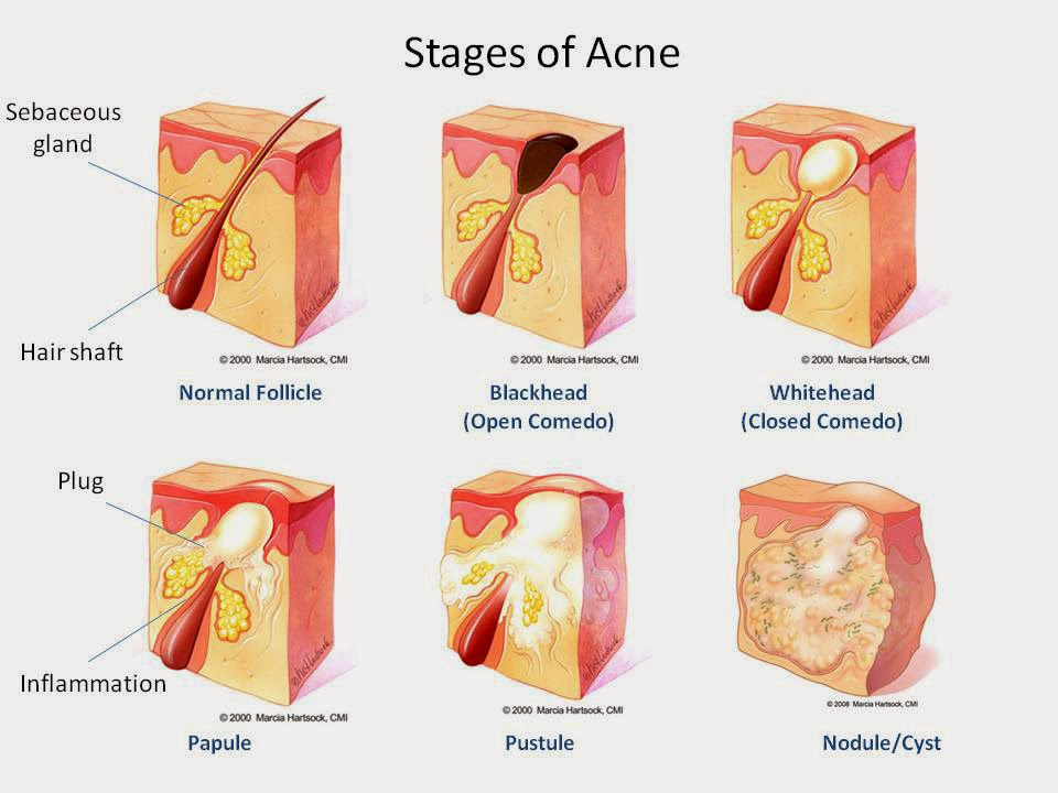 aloe vera contro acne